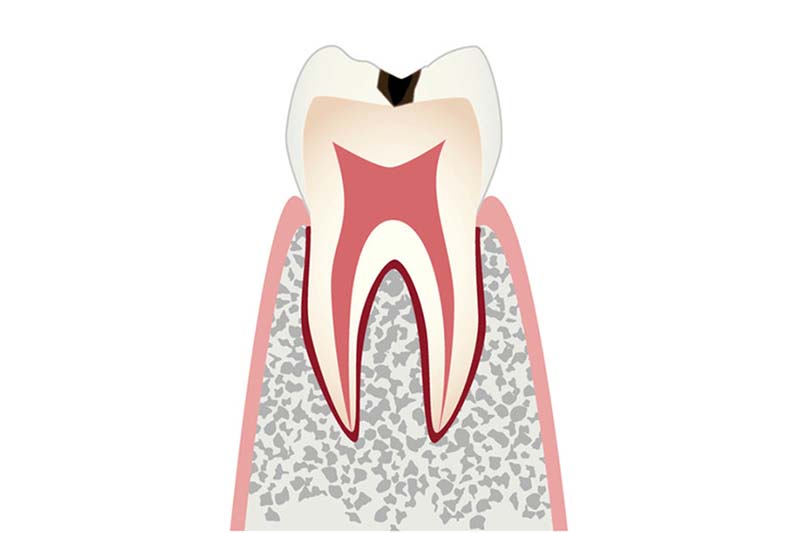 C1エナメル質に小さな穴が開いたむし歯
