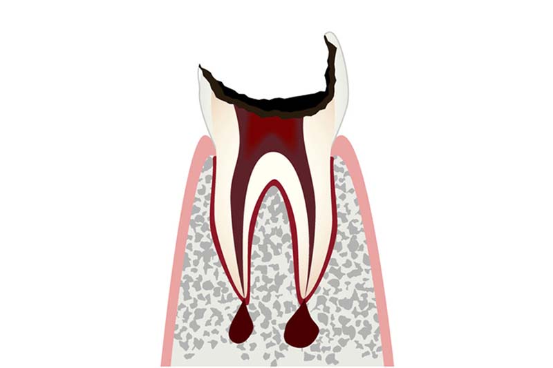 C4歯の根(歯質)が失われた歯